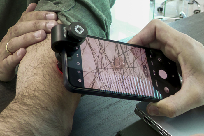 Investigadora en un laboratorio de genómica analizando muestras de ADN para el estudio de melanoma acral.