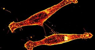 Representación microscópica de neuronas y proteínas relacionadas con la enfermedad de Huntington.