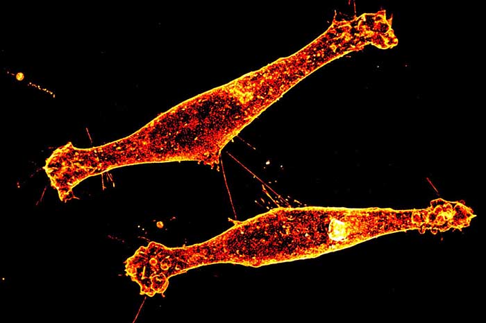 Representación microscópica de neuronas y proteínas relacionadas con la enfermedad de Huntington.