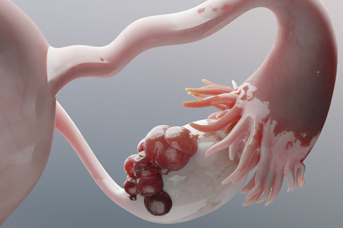 Detección temprana y síntomas del cáncer de ovario en México.
