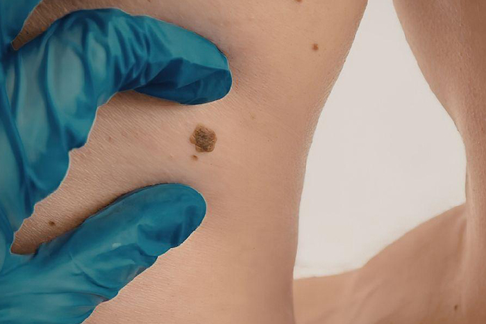 Especialista analizando un lunar en la piel de un paciente para detectar posibles síntomas de melanoma cutáneo.