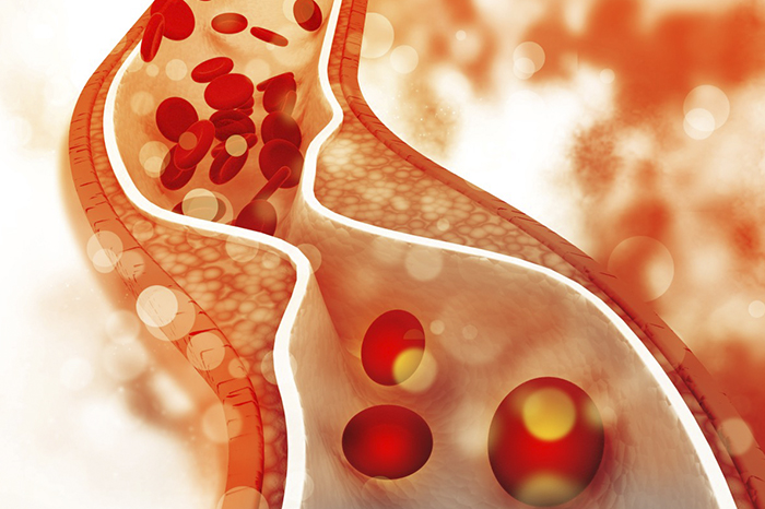 Representación médica del flujo sanguíneo en una arteria con acumulación de placas de colesterol y aterosclerosis.