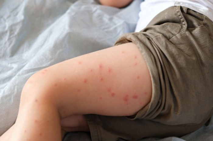 Personal sanitario refuerza acciones contra un brote de sarampión en Xalapa, Veracruz.