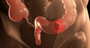 Detección temprana del cáncer colorrectal y pruebas de tamizaje recomendadas desde los 45 años