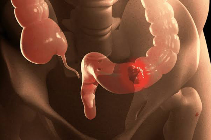 Detección temprana del cáncer colorrectal y pruebas de tamizaje recomendadas desde los 45 años